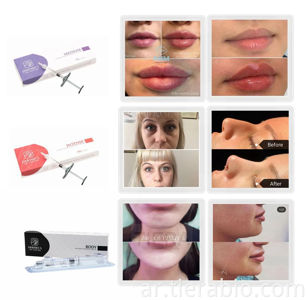 Dermeca 1ml Reshape Sexy Lip Ha مرتبط بحمض الهيالورونيك حشو جلدي للشراء (متوسط ​​1 مل / 2 مل)